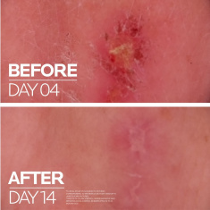 La Roche-Posay Cicaplast Протокол за увредена и раздразнена кожа